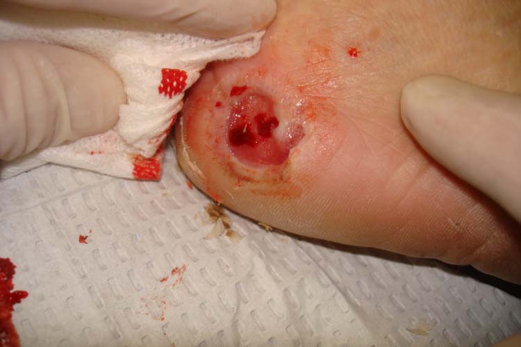 How are diabetic skin sores treated?