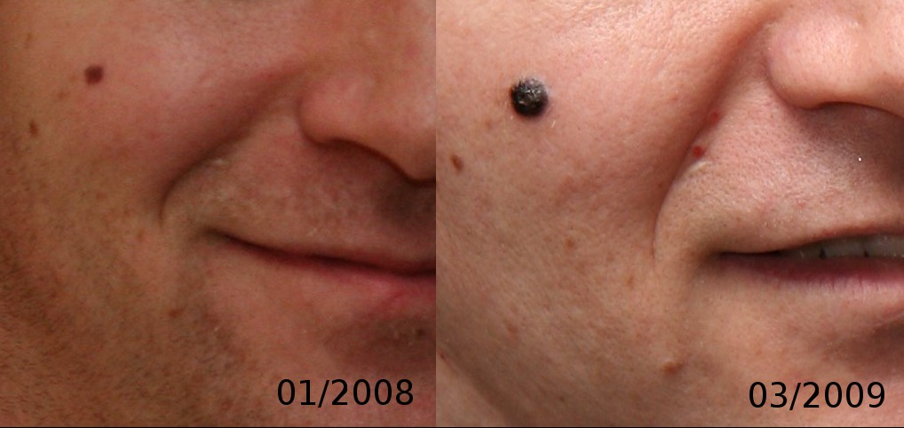 NodularMelanomaEvolution.jpg