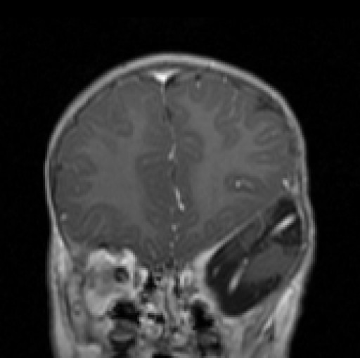 File:Orbitadysplasie bei Neurofibromatose Typ 1 - MRT - T1 coronar mit KM - 008.jpg