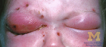 File:Orbital cellulitis.jpg