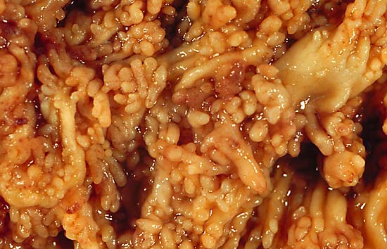 File:Chronic Ulcerative Colitis 1.jpg