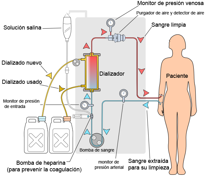 File:Hemodiálisis.png