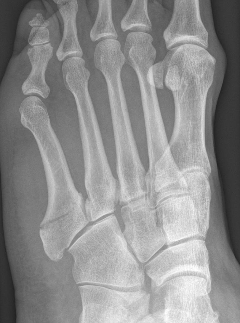 Stress fracture. Перелом Джонса 5 плюсневой. Перелом Джонса плюсневой кости. Диафиза 5 плюсневой кости. Диафиз 1 плюсневой кости.