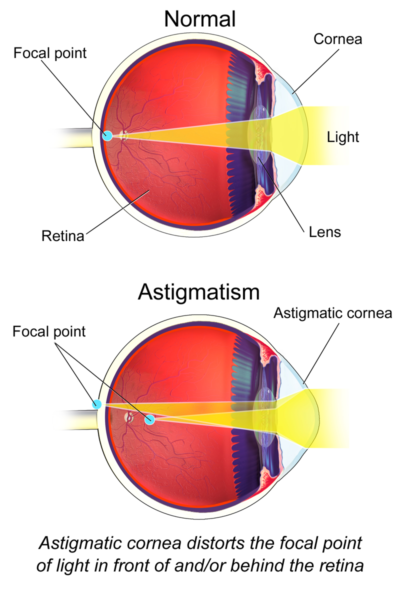 astigmatizmus myopia emberi test látása