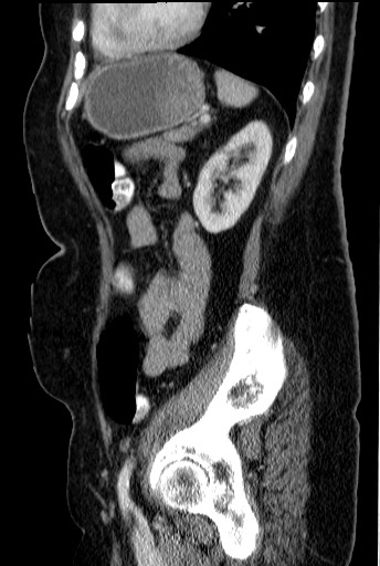 File:Bouveret-Syndrom case 001 - CT - sagittal - 030.jpg