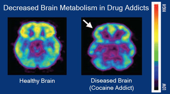 Whole-brain tracking of cocaine and sugar rewards processing