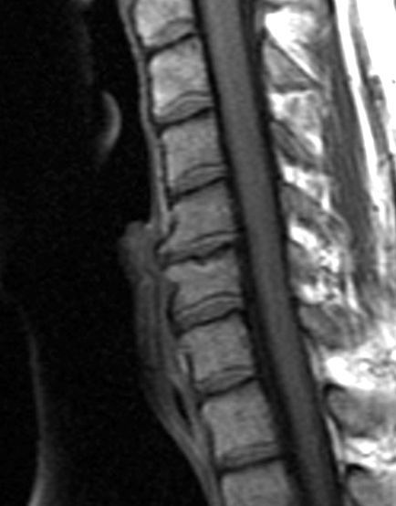 Cervical Spine MRI showing degenerative changes closeup