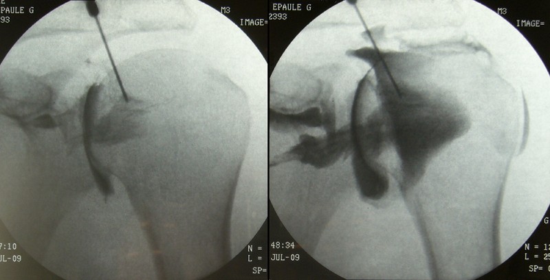 File:Arthrographie epauleGauche.jpg