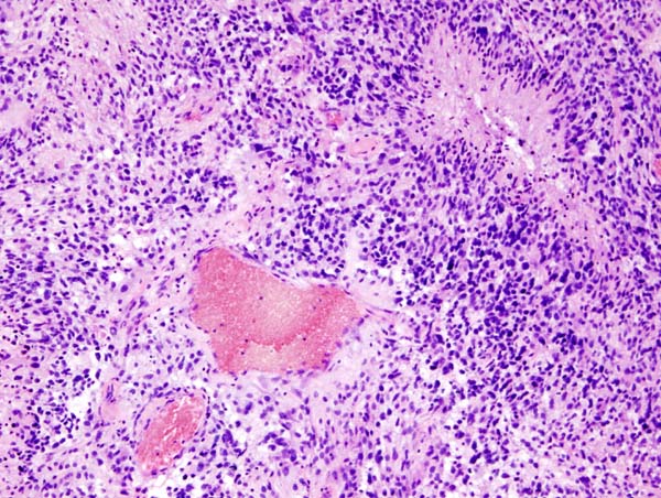 File:Glioblastoma (3).jpg