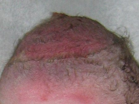 https://upload.wikimedia.org/wikipedia/commons/9/93/Vacuum_Extraction_bruised_scalp.JPG