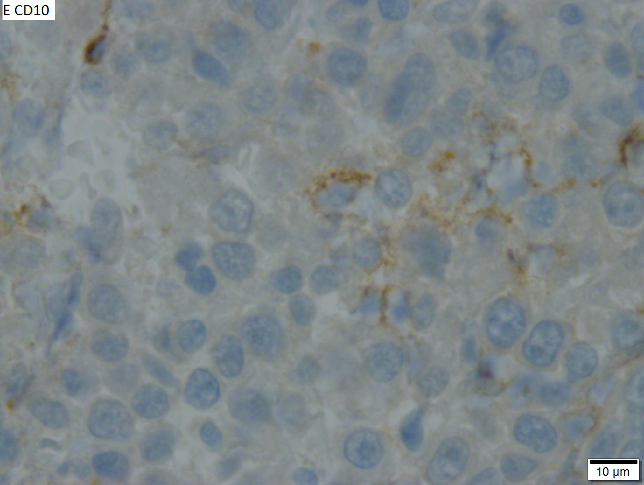 High grade B cell lymphoma involving liver