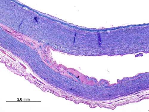 File:Aortic dissection (1) Victoria blue-HE.jpg