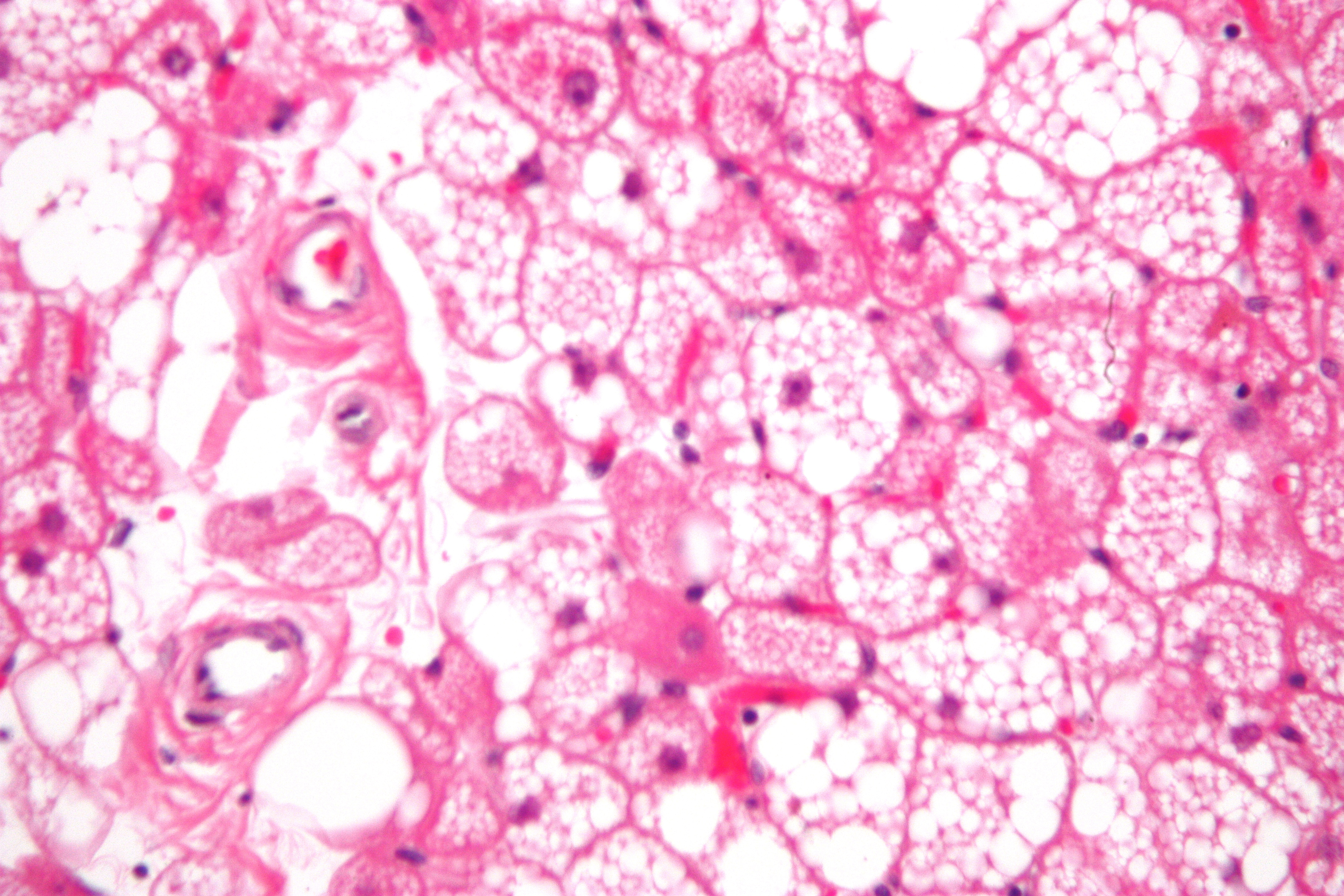 Spindle cell lipoma. (A) A fatty-tumor with interspersed fibro-myxoid