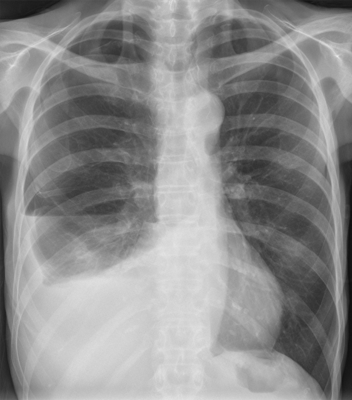 mild pneumothorax x ray