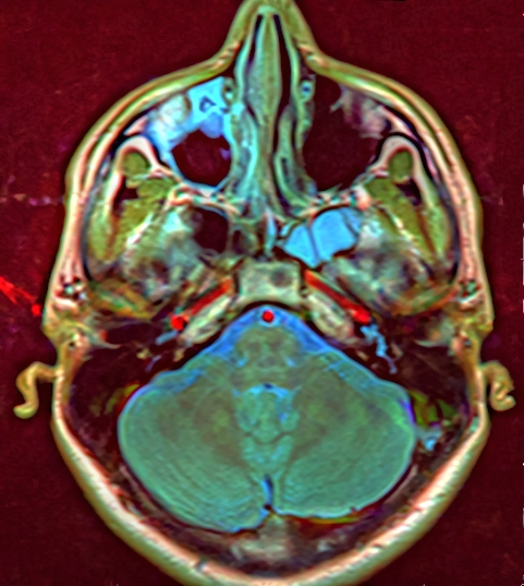 File:Brain MRI 110439 rgbca.png