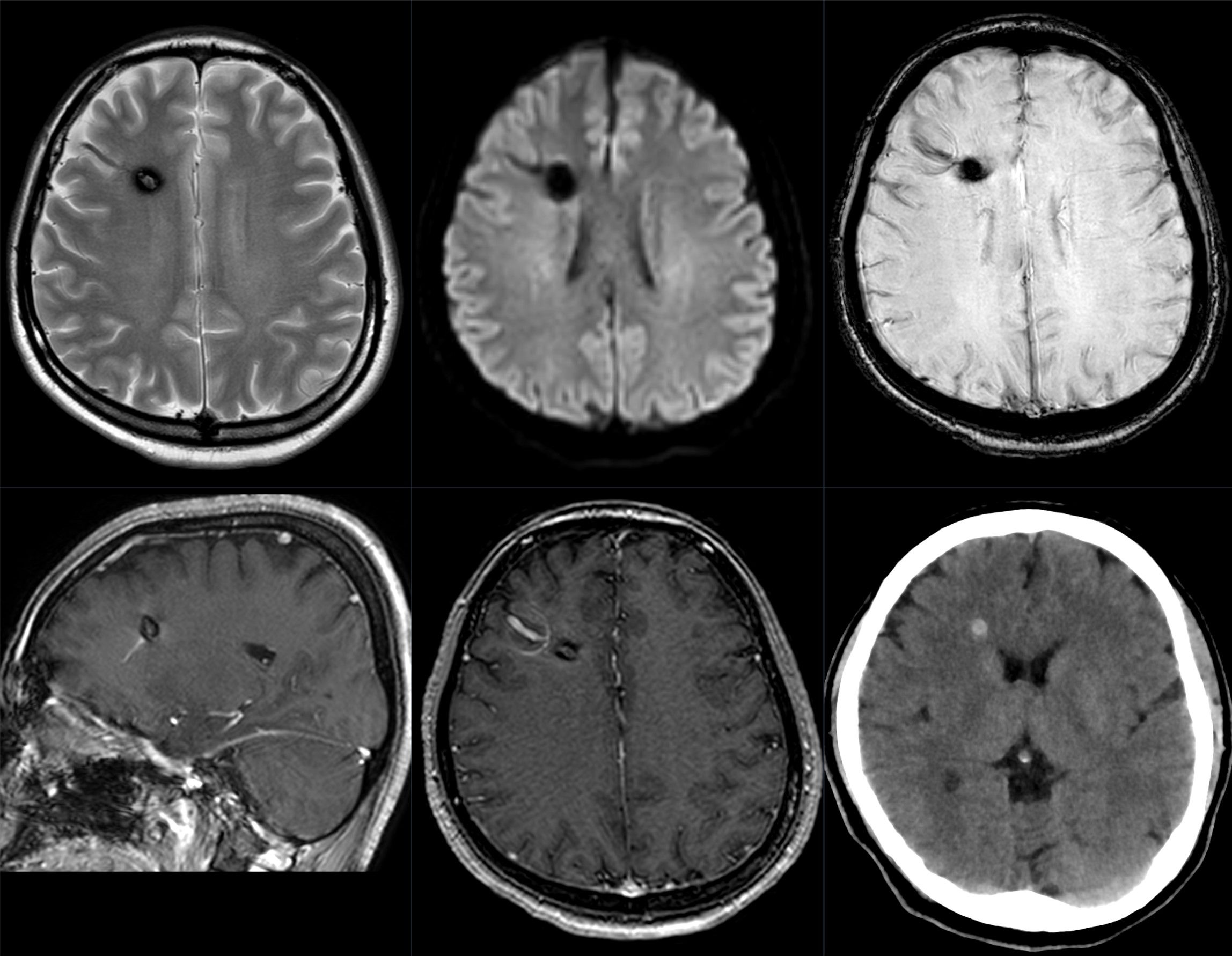 Brain 71. Кавернома головного мозга кт. Кавернома на кт. Кавернома головного мозга мрт.