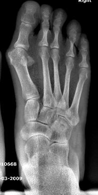 تحول مفصل إصبع القدم الكبير الأيسر في اتجاه جانبي بسبب الإفراط في التصحيح.