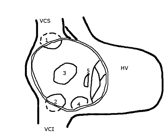 Schematic drawing showing the location of different types of ASD, the view is into an opened right atrium. HV: right ventricle; VCS: superior vena cava; VCI: inferior vena cava 1: upper sinus venosus defect; 2: lower sinus venosus defect; 3: secundum defect; 4: defect involving coronary sinus; 5; primum defect.