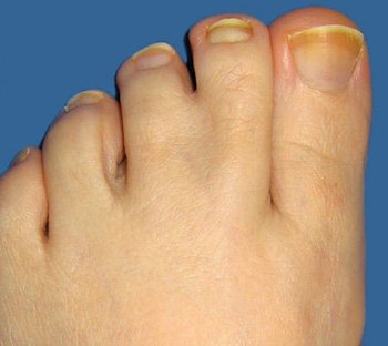 File:Webbed toes b4.jpg