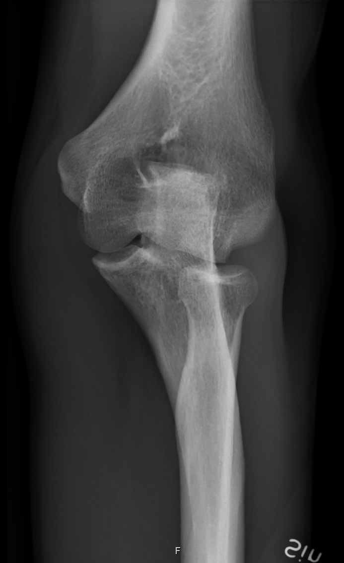 File:X-ray of normal elbow by 30 degrees internal oblique ...