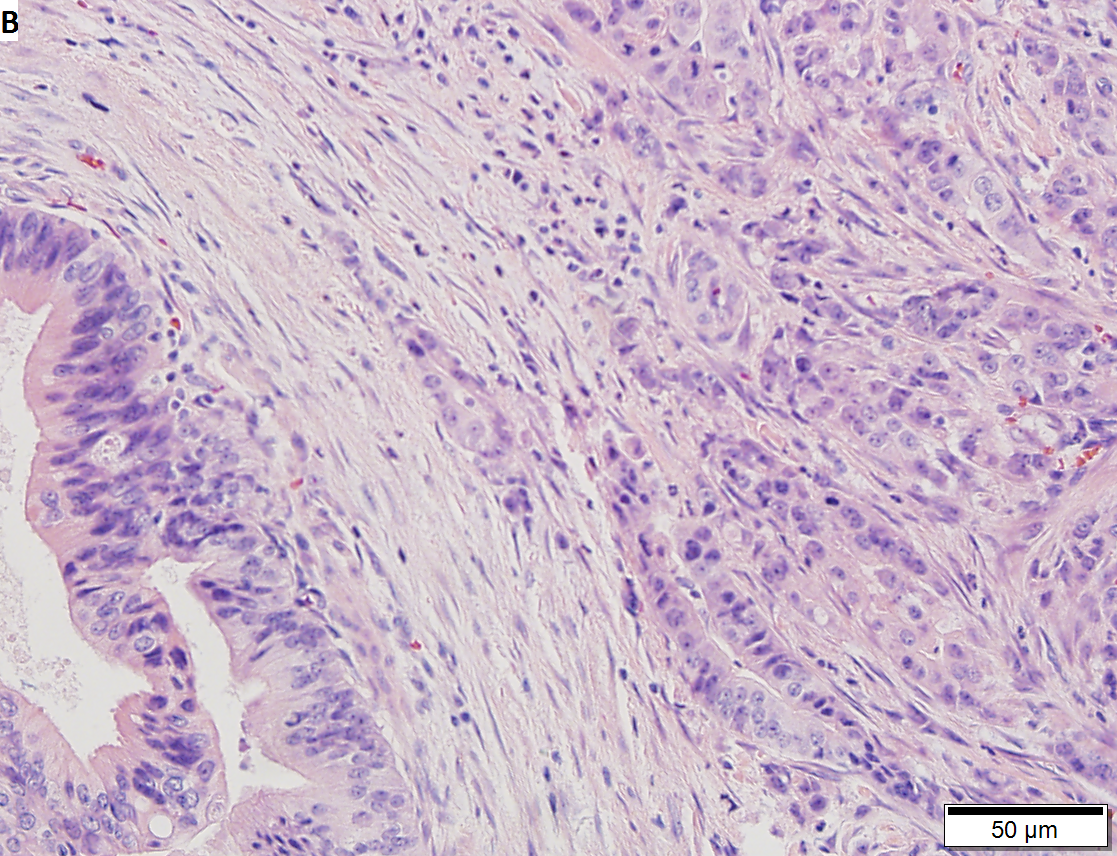 Moderately differentiated adenocarcinoma of gallbladder