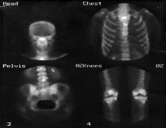 File:Gamma Camera Bone Scan Head Cest Knees Pelvis.jpg