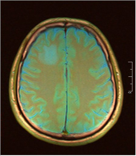 File:Lung ca brain mri 06.jpg