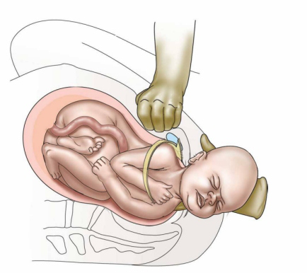 Shoulder Dystocia Wikipedia