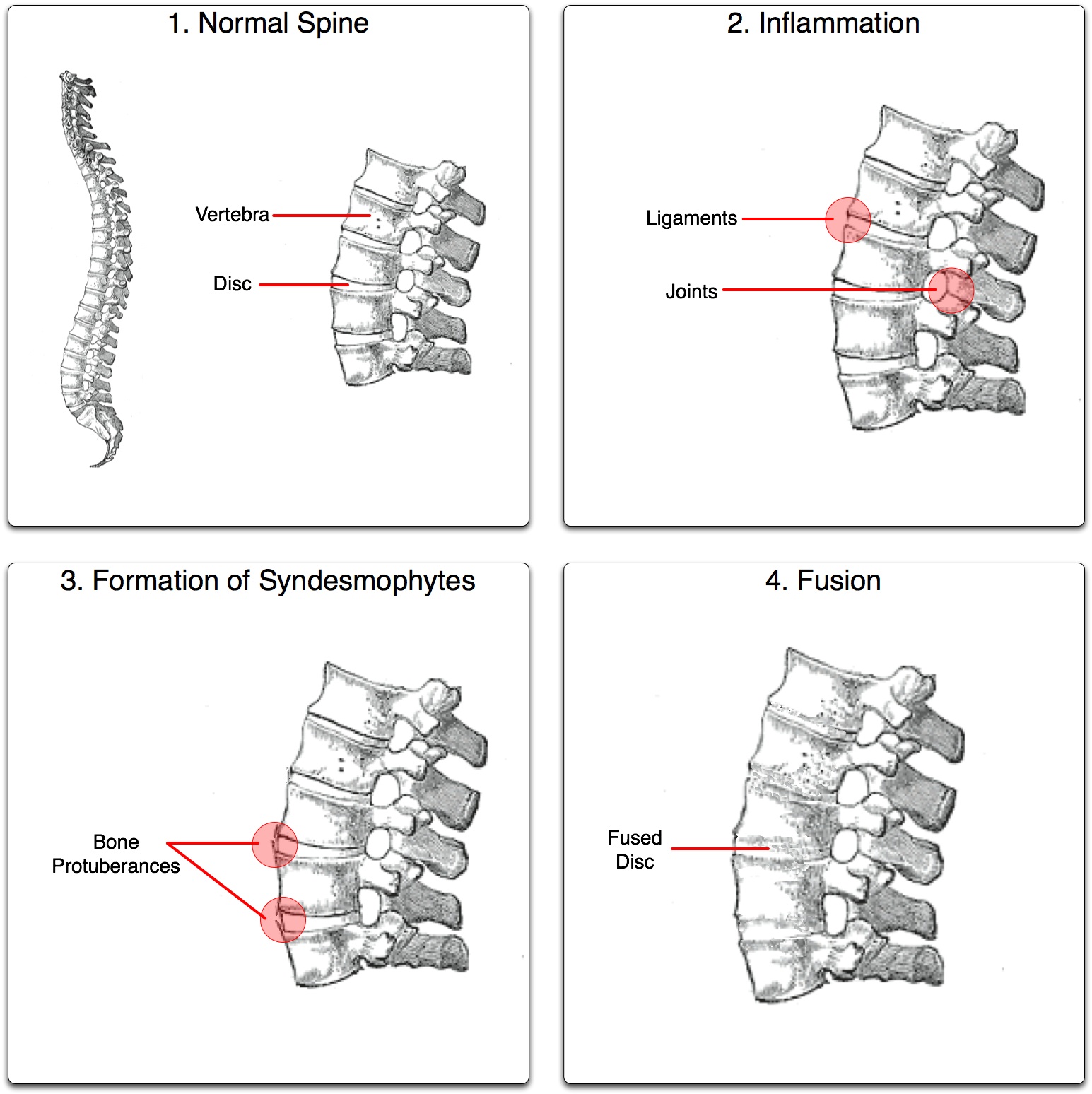 Video Abstract: Simplified Ankylosing Spondylitis Disease Activity Score  (SASDAS) Versus ASDAS 