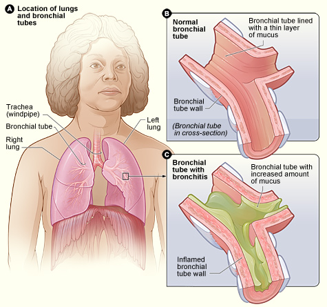 File:Bronchitis.jpg