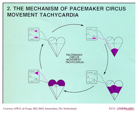 File:DVA1739 (CardioNetworks ECGpedia).jpg