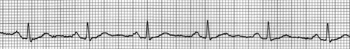 Derivación I de un electrocardiograma