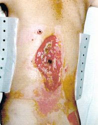 File:Electrical burn entrance wound.jpg