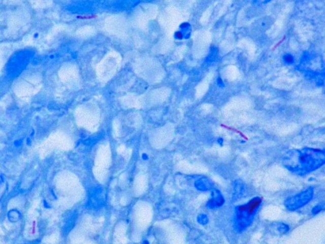 Bacilli di Koch (fucsia) in tessuto (blu), colorazione di Ziehl-Neelsen