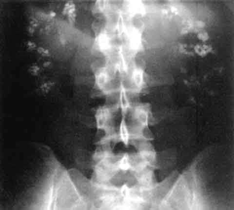 Renal Tubular Acidosis Wikipedia