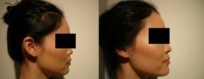 Chin filler Before and After