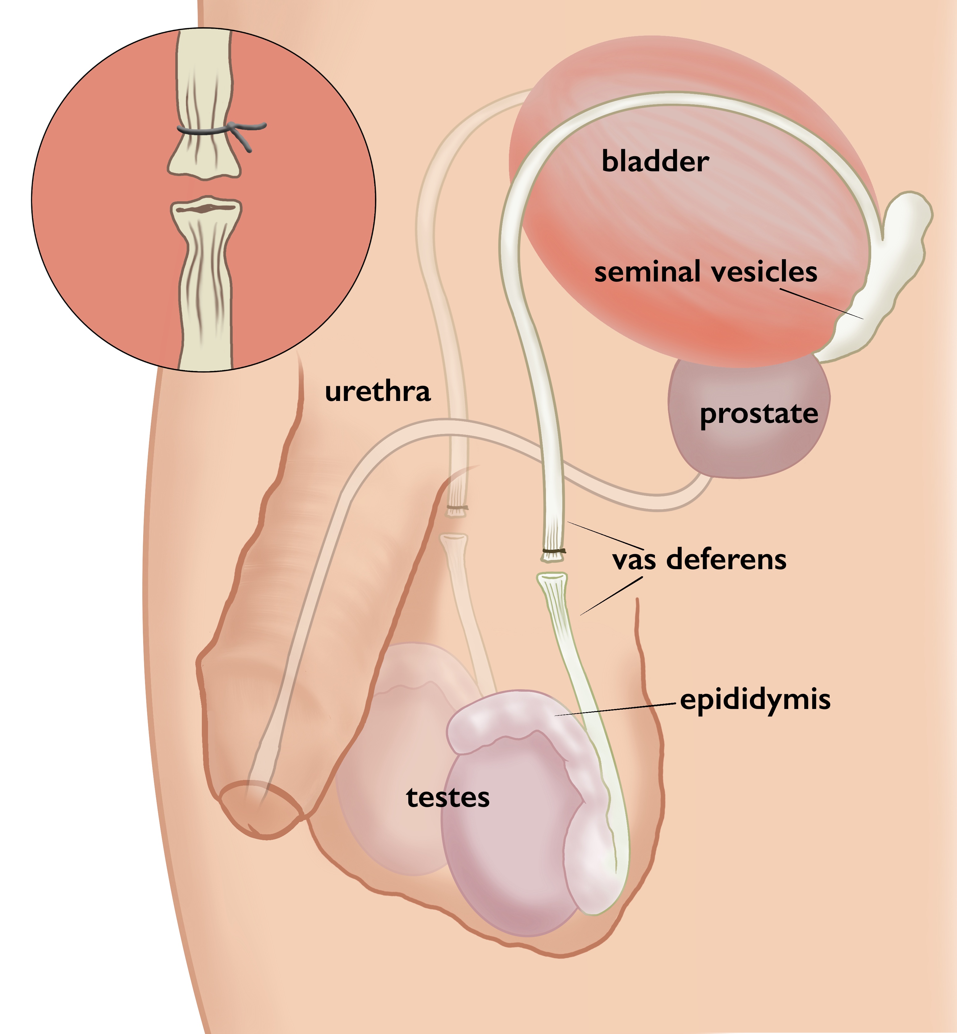 Vasectomy Wikiwand