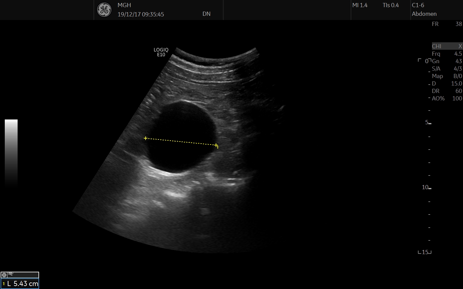 renal cyst ultrasound