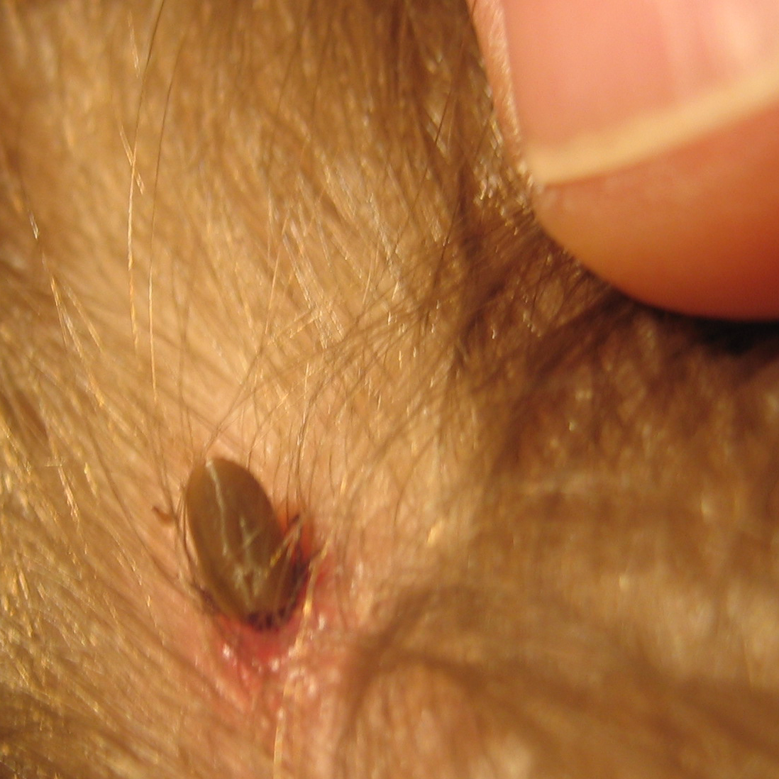 Skin tag - Wikipedia