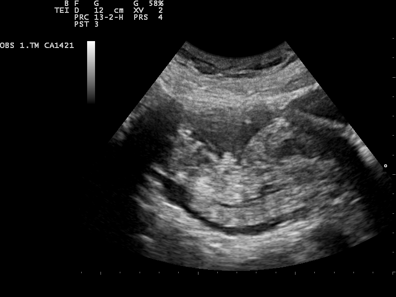 Pregnant Ultrasound