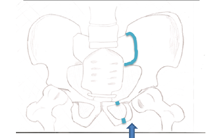 File:Anterior view, Vertical Shear Fracture.png