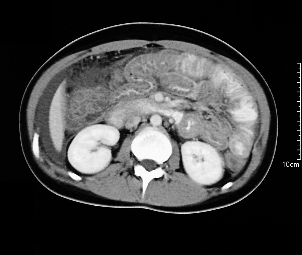 datei-eosinophilic-gastroenteritis-ct-jpg-wikipedia