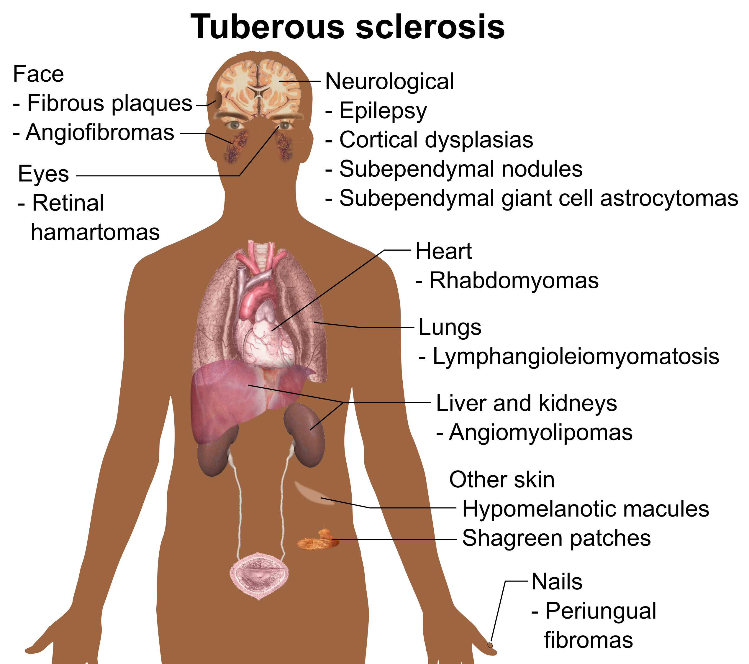angiofibroma tuberous sclerosis