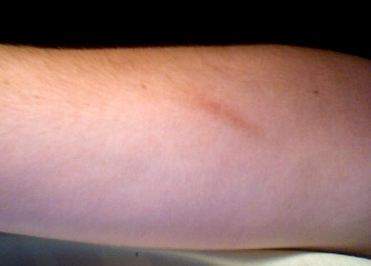 File:Very-minor-scar.jpg