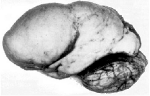 Lissencephaly Wikipedia