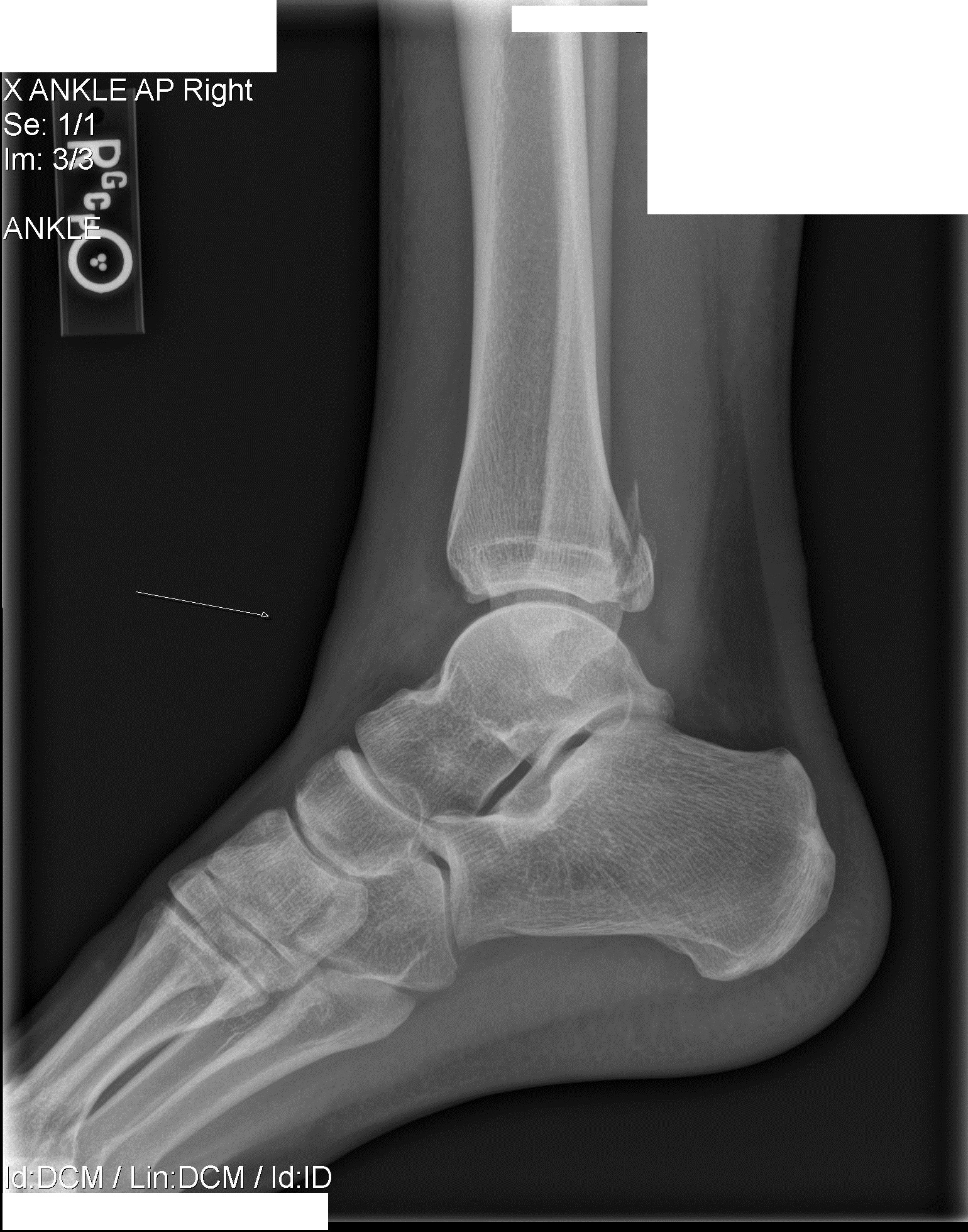 Left Tibial Plafond Fracture Icd 10