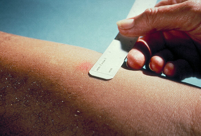 https://upload.wikimedia.org/wikipedia/commons/9/9d/Mantoux_test.jpg