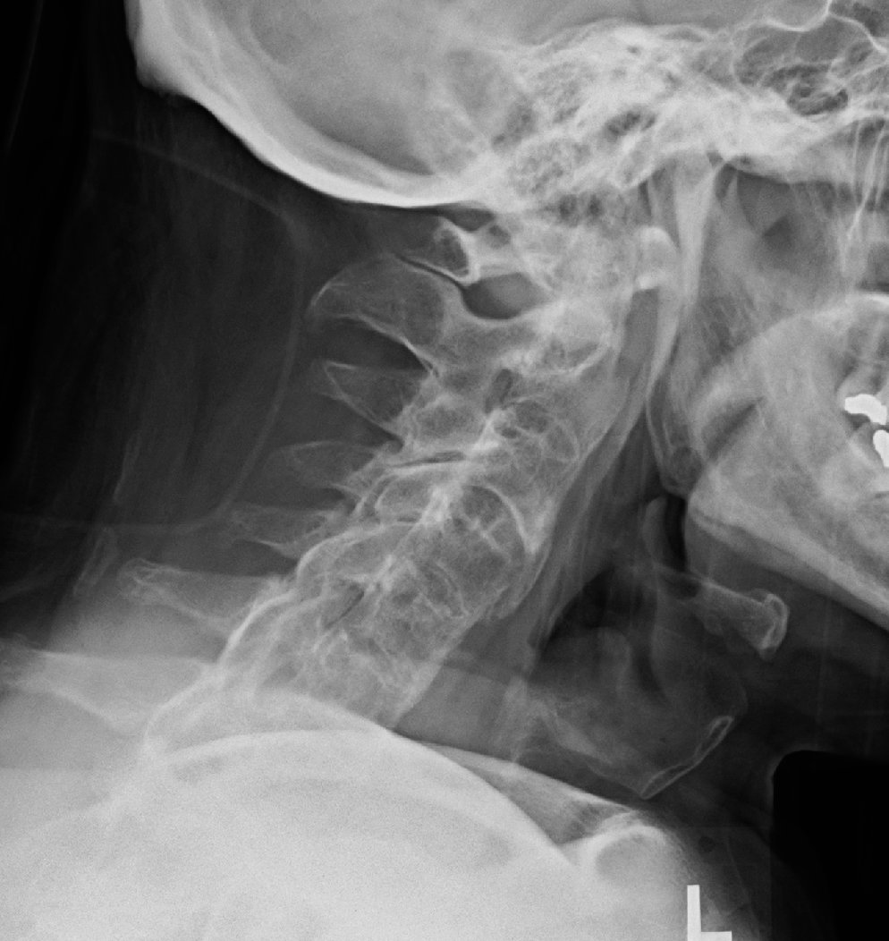 Simplified Ankylosing Spondylitis Disease Activity Score (SASDAS) Versus  ASDAS: A Post Hoc Analysis of a Randomized Controlled Trial