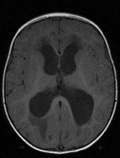 File:Medulloblastom - MRT - T1 axial nativ - 022.jpg