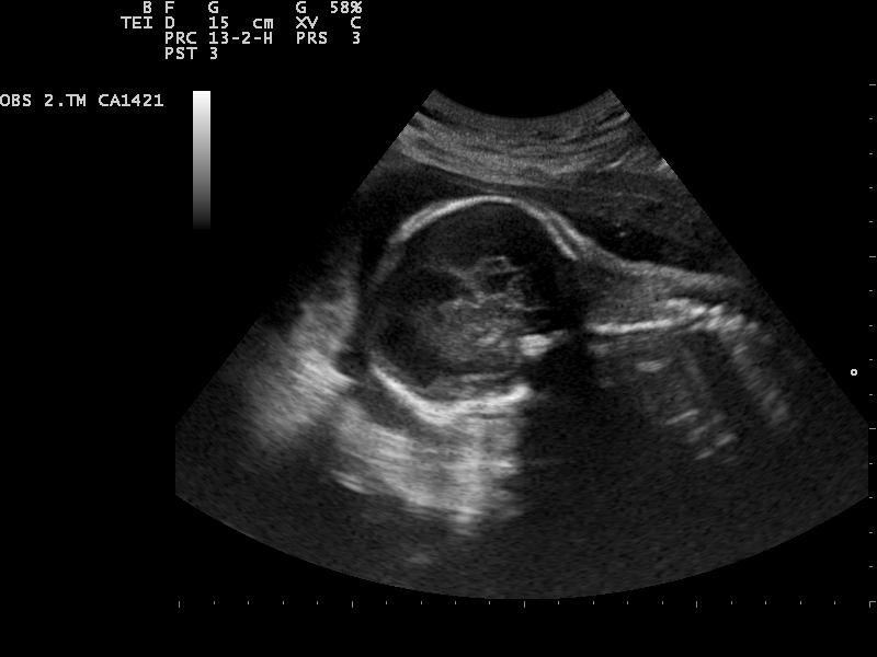 File:Ultrasound Scan ND 0120095833 1003181.png